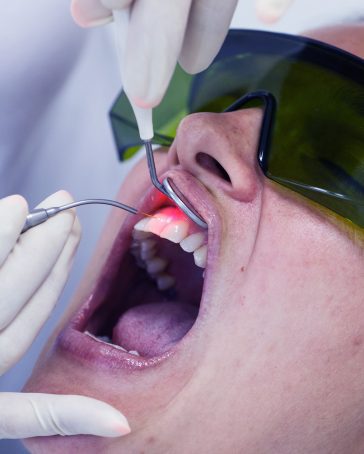 Laser Bacterial Reduction Therapy (LBR) available at Pacifica Dental