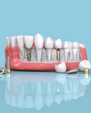 Dental Implants - Frequently Asked Questions